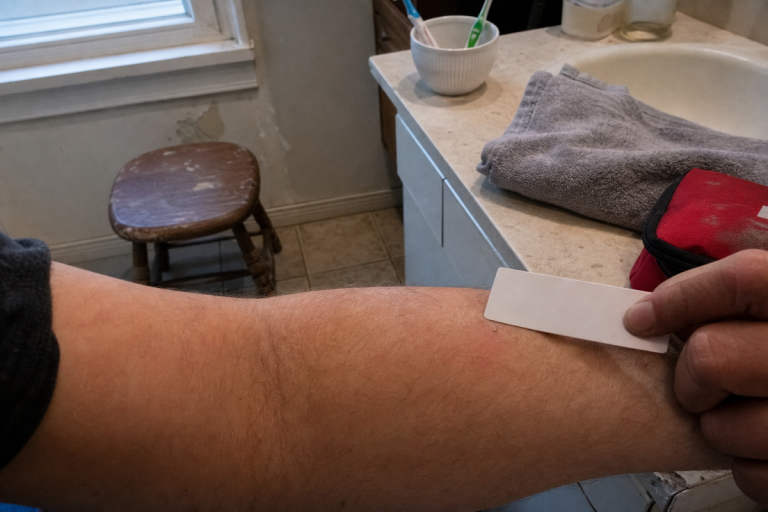 Retrait d'un dard en raclant la peau avec une carte rigide